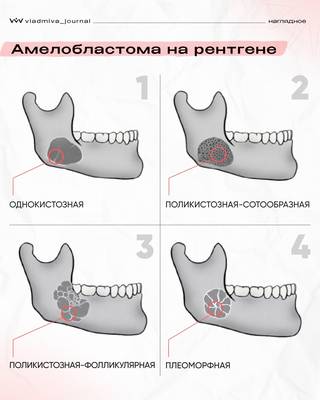 Амелобластома на рентгене: ключевые признаки опухоли.